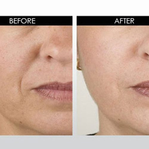 سرم ضد چروک و پرکننده خطوط آرژیرلین 10% اوردینری ORDINARY