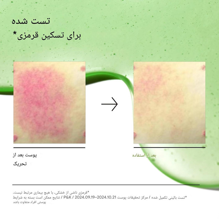 سرم آزلائیک اسید 10% و هیالورون (ضدجوش، تسکین دهنده، ضدالتهاب و آبرسان) آنوا